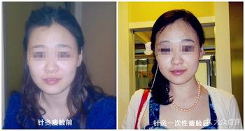 瘦颧骨图片,揭秘瘦颧骨的美丽秘诀